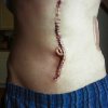Erin Geideman - Ian's scar, ten day out of hospital