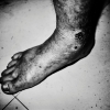 Scott Typaldos - Switzerland - Alistair's foot with phlegmon